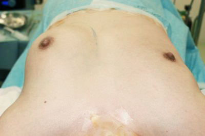 抜去後のバスト