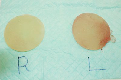 抜去したシリコンバッグ