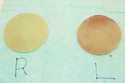 抜去したシリコンバッグ