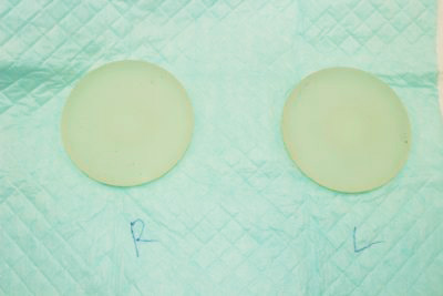 抜去したシリコンバッグ