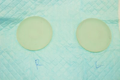抜去したシリコンバッグ