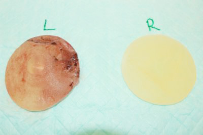 抜去したシリコンバッグ