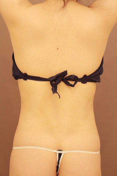 お腹・腰の脂肪吸引 術後3カ月の経過