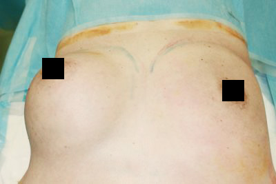 抜去後のバスト