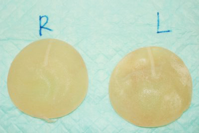 抜去したシリコンバッグ