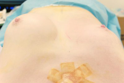 抜去後のバスト