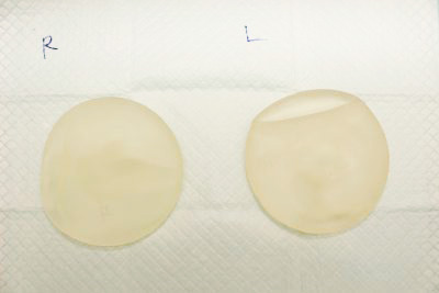 抜去したシリコンバッグ