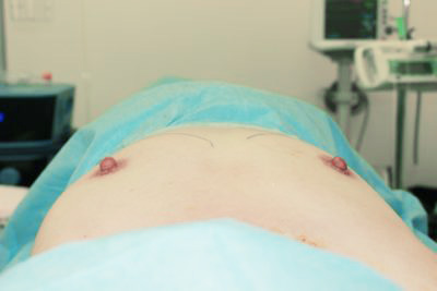 抜去後のバスト