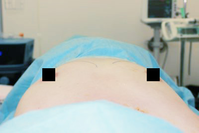 抜去後のバスト