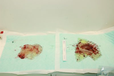 抜去したシリコンバッグ