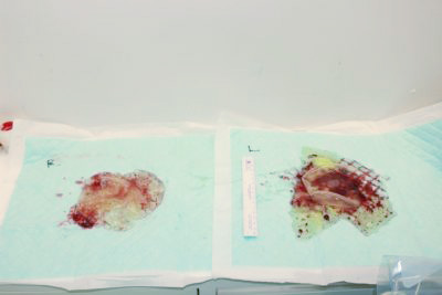 抜去したシリコンバッグ