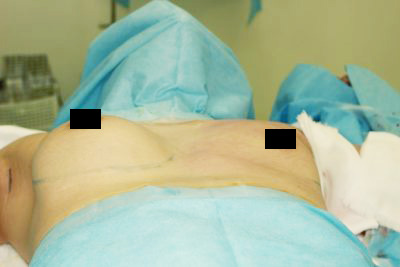 抜去後のバスト