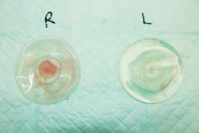 抜去したシリコンバッグ