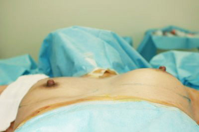 抜去後のバスト