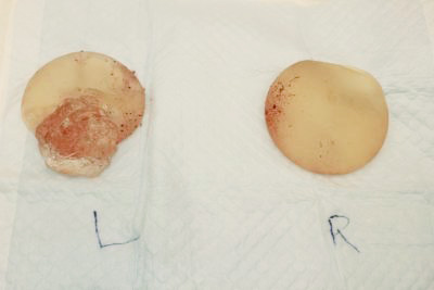抜去したシリコンバッグ