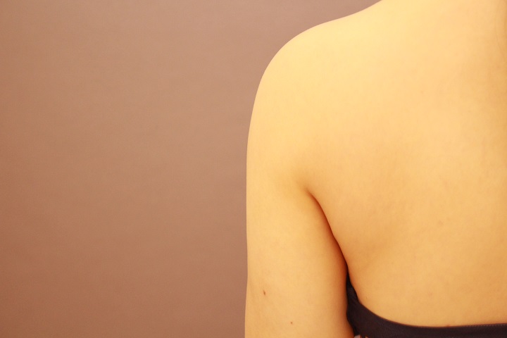 二の腕・肩の脂肪吸引　術後3カ月の経過