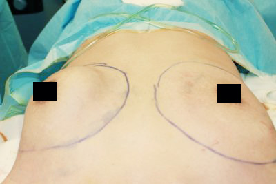 抜去後のバスト