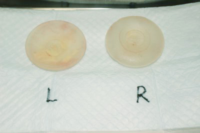 抜去したシリコンバッグ