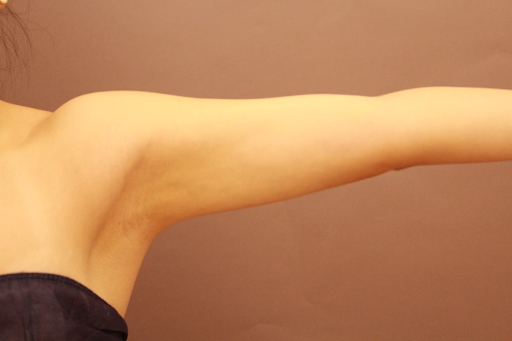 二の腕・肩の脂肪吸引　術後1カ月の経過