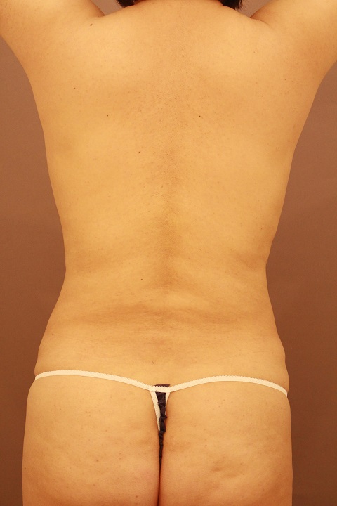 腰の脂肪吸引　術後1カ月の経過