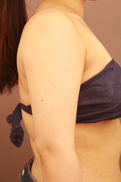二の腕・肩の脂肪吸引　術後1カ月の経過