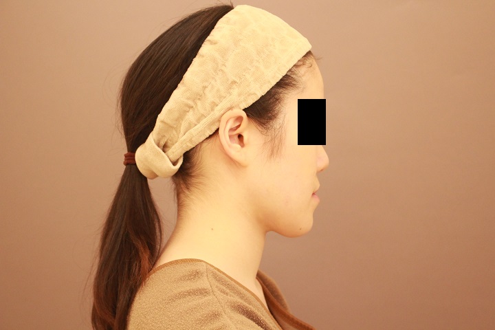 お顔の脂肪吸引　術後1カ月の経過