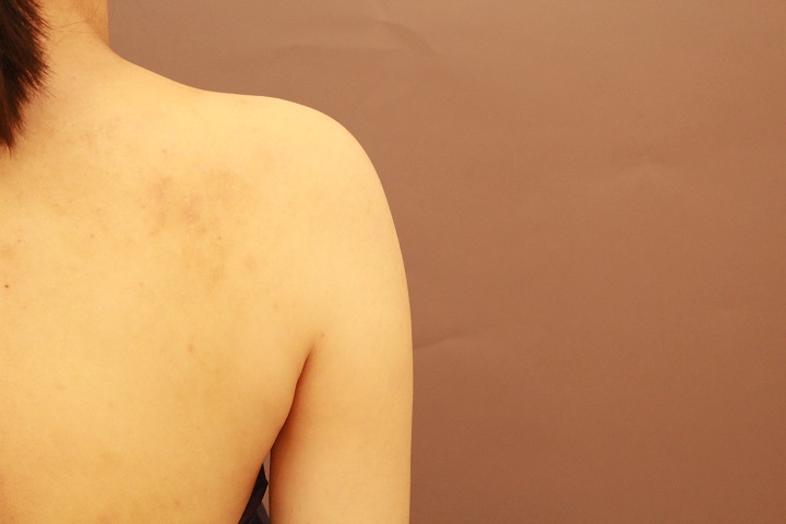 二の腕・肩の脂肪吸引　術後1カ月の経過