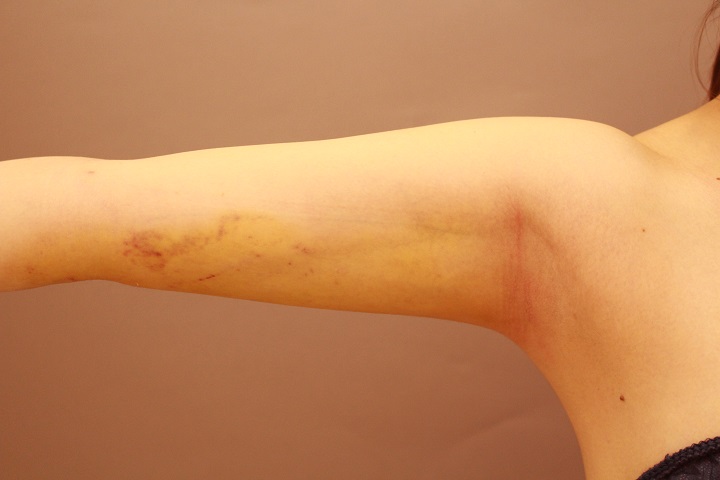 二の腕・肩の脂肪吸引　術後1週間の経過