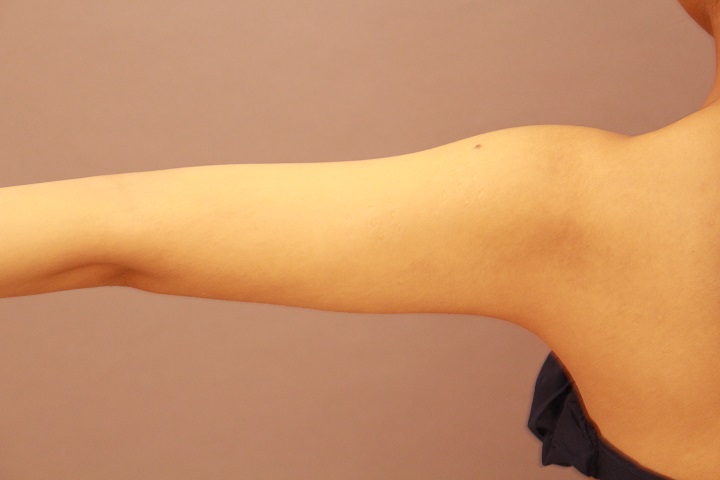 二の腕・肩の脂肪吸引　術後3カ月の経過