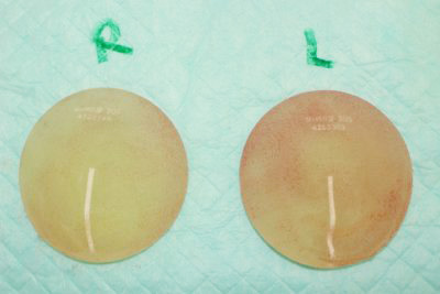 抜去したシリコンバッグ