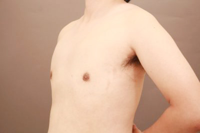 女性化乳房の診断