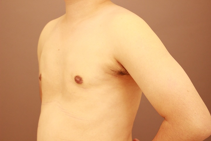 女性化乳房 術後3カ月の経過