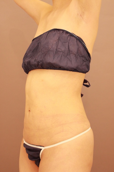 お腹・腰の脂肪吸引 術後3カ月の経過