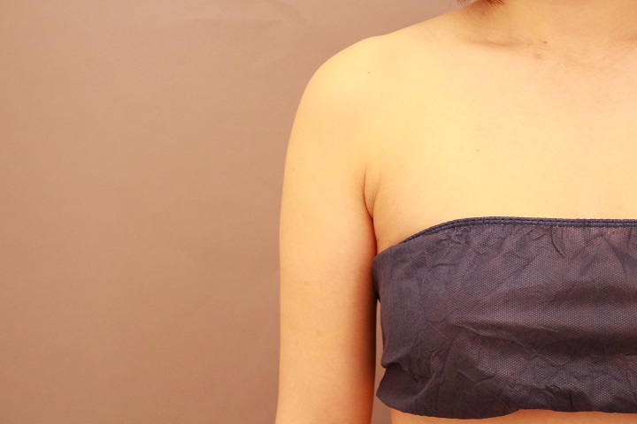 二の腕・肩の脂肪吸引　術後3カ月の経過