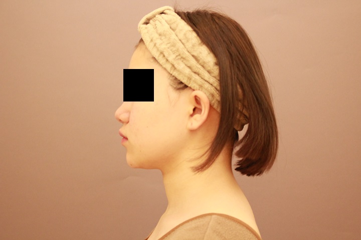 お顔の脂肪吸引　術後3カ月の経過