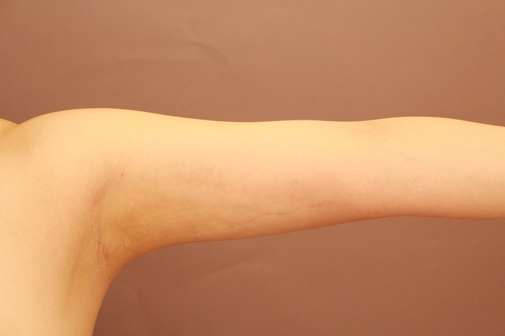 二の腕・肩の脂肪吸引　術後1カ月の経過