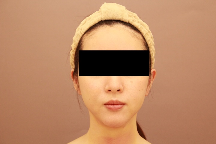 お顔の脂肪吸引　翌日の様子