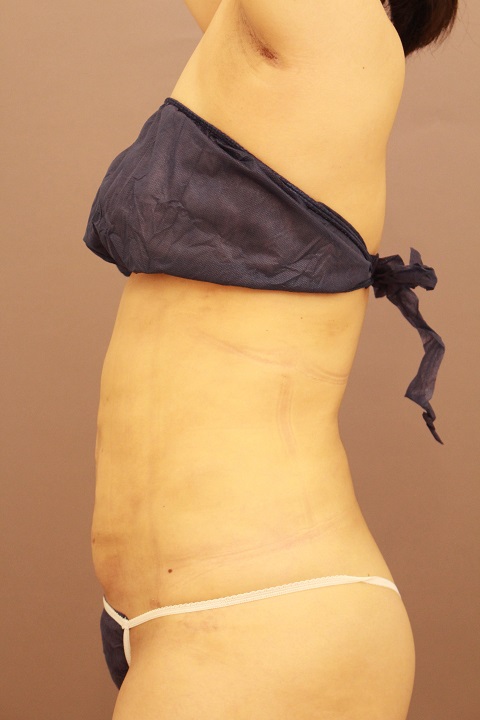 お腹・腰の脂肪吸引 術後1カ月の経過