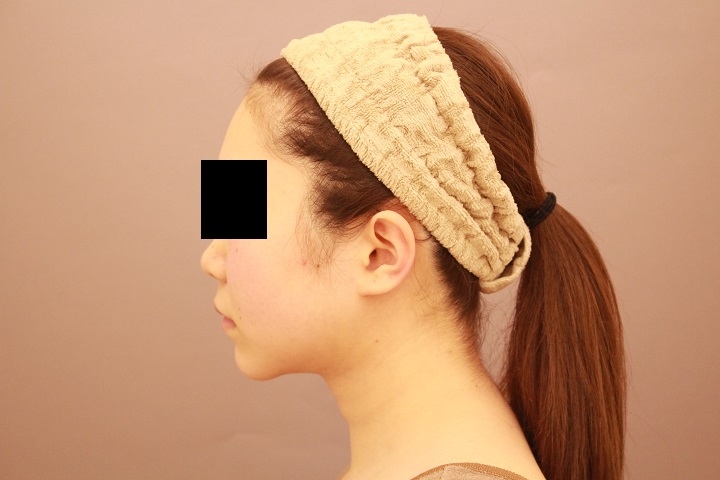 お顔の脂肪吸引　術後1カ月の経過