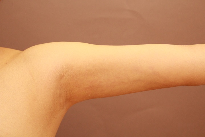 元々痩せている体型の二の腕・肩の脂肪吸引　術後1カ月の経過