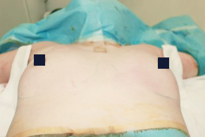 抜去後のバスト