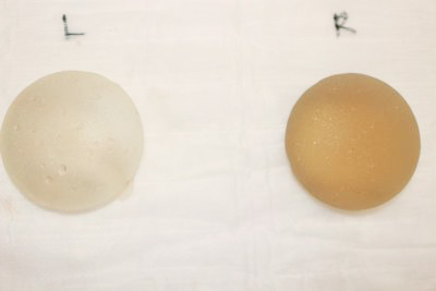 抜去したシリコンバッグ
