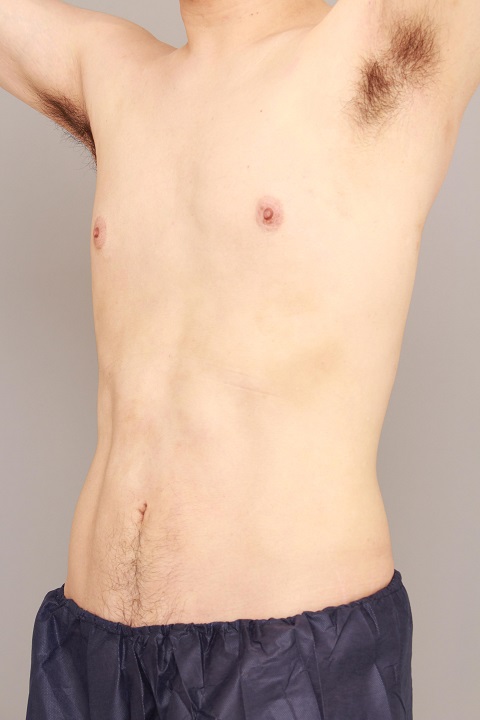 男性のお腹の脂肪吸引 術後1カ月の経過