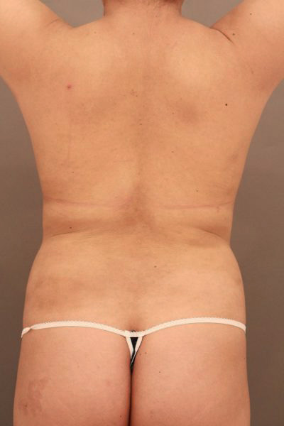 腰の脂肪吸引の重要性