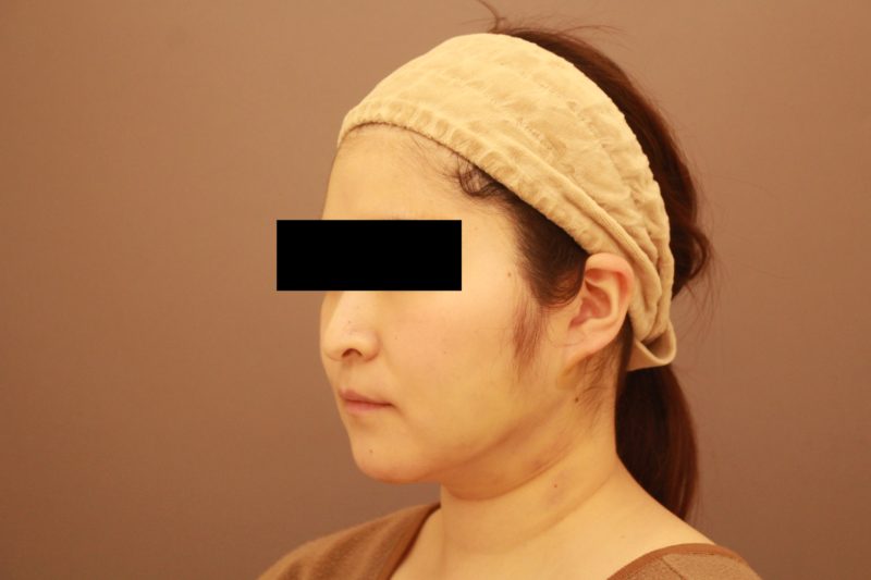 ほほ顎は脂肪吸引がオススメです