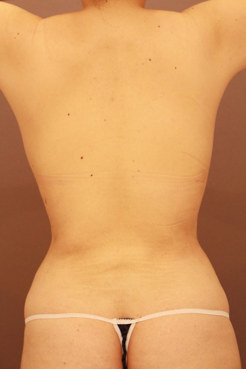 腰の脂肪吸引について