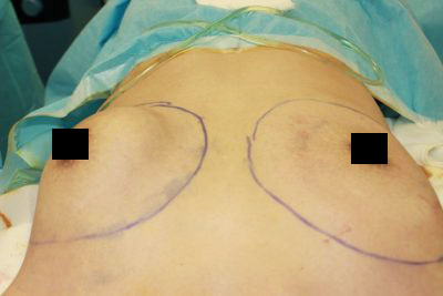 抜去後のバスト