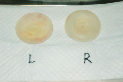 抜去したシリコンバッグ