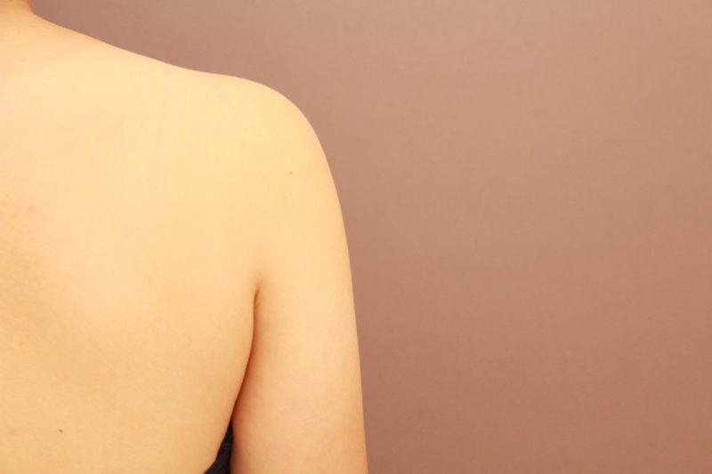 二の腕、肩の脂肪吸引について