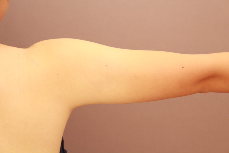 二の腕、肩の脂肪吸引